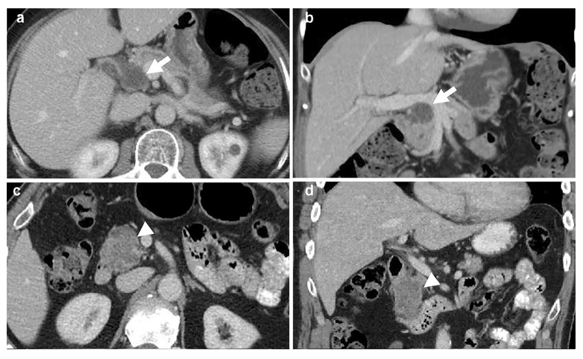 CT image and radiomics visualization for the pancreatic cyst study