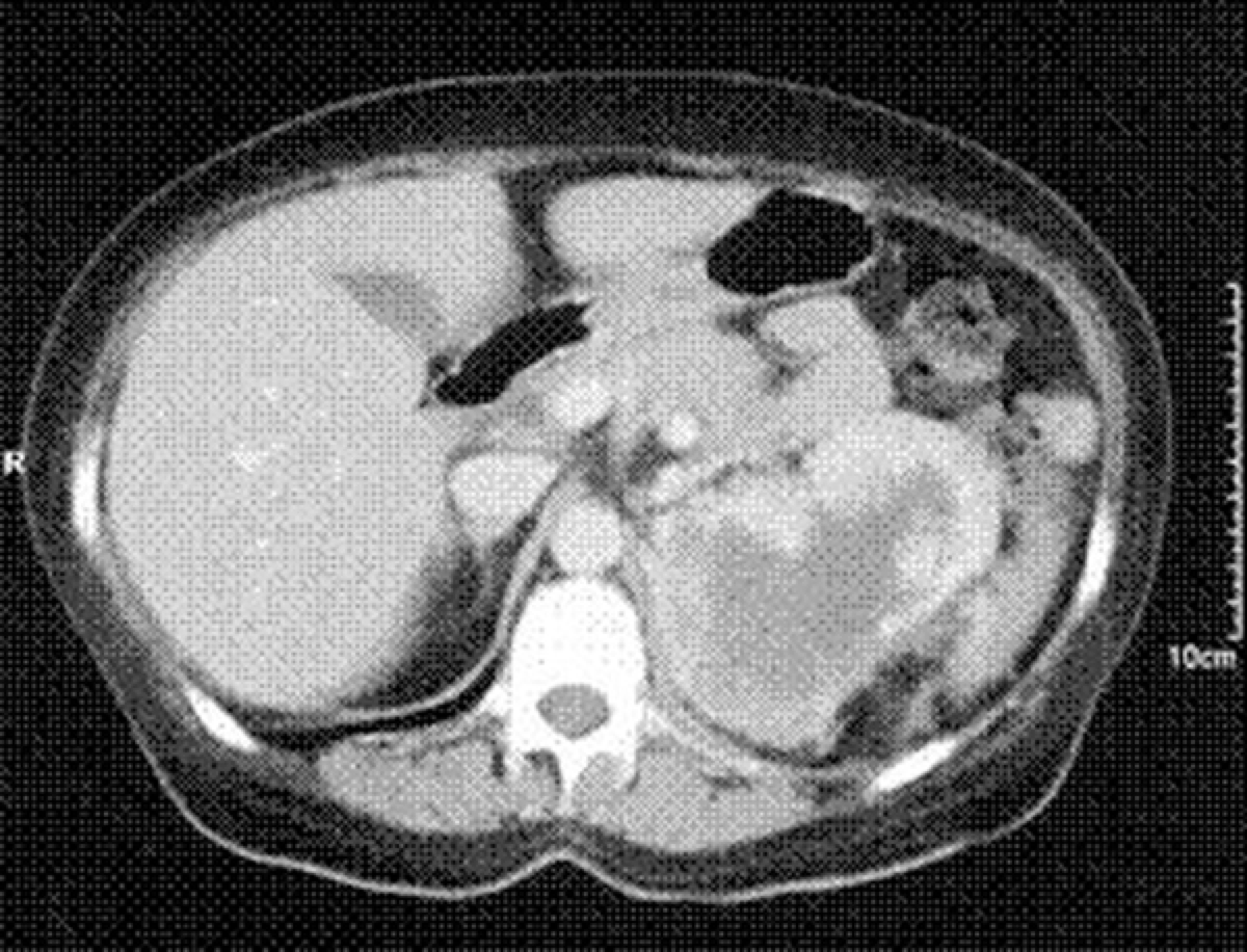 Medical illustration of renal cell carcinoma